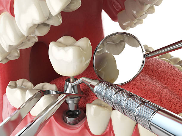 Best Urgent Dental Care for Toothache in Spring Ridge, MD